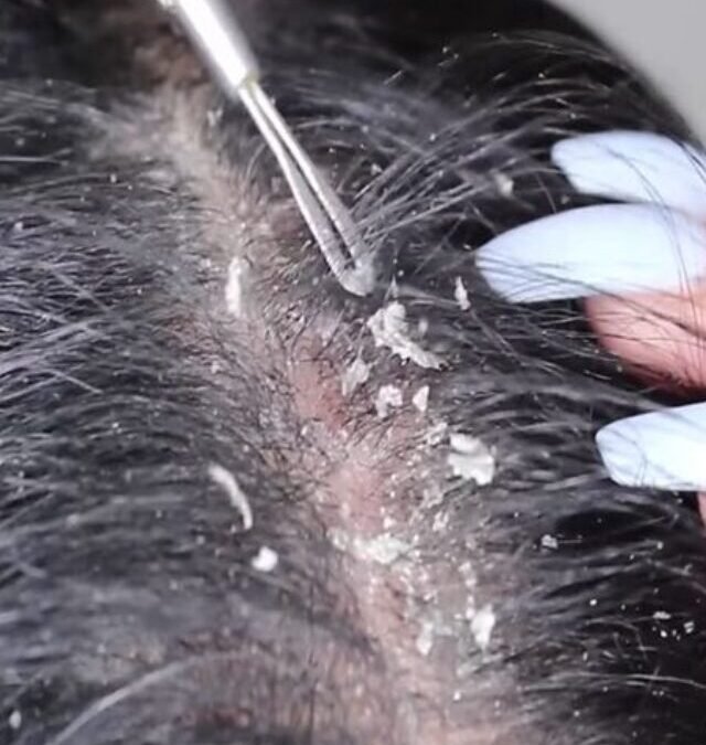 Effective Remedies to Relieve Dandruff Problems