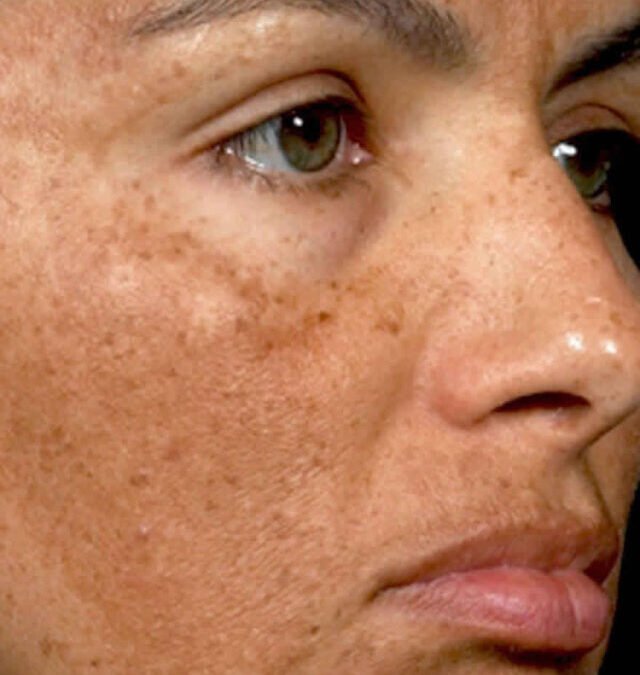 Reduce Dark Spots: Effective Home Remedies with Potato, Papaya, Lentils, and Nutmeg