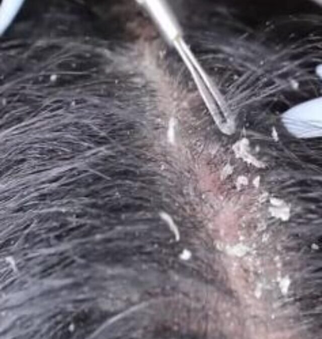 These Common Hair Care Mistakes Create a Thick Layer of Dandruff on Your Scalp