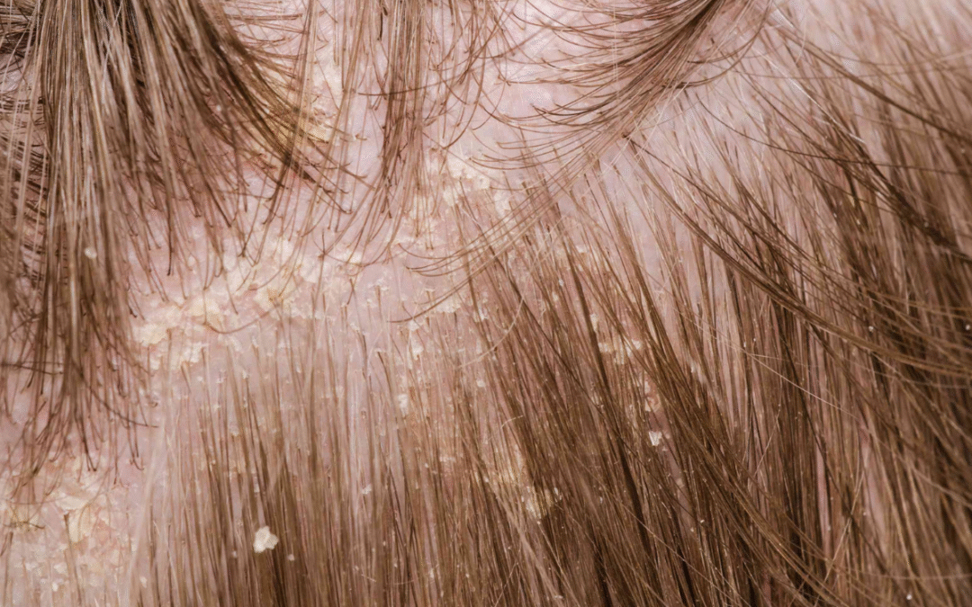 dandruff causes scalp care mistakes dry scalp treatment itchy scalp remedies hair fall prevention natural hair care tips