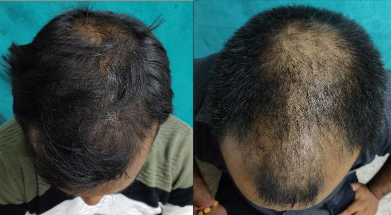 गंजापन और हेयर फॉल होगा जड़ से खत्म! बस 10 रुपये में ‘घर पर भृंगराज तेल’ बनाएं और पाएं घुटनों तक लंबे, काले और घने बाल!