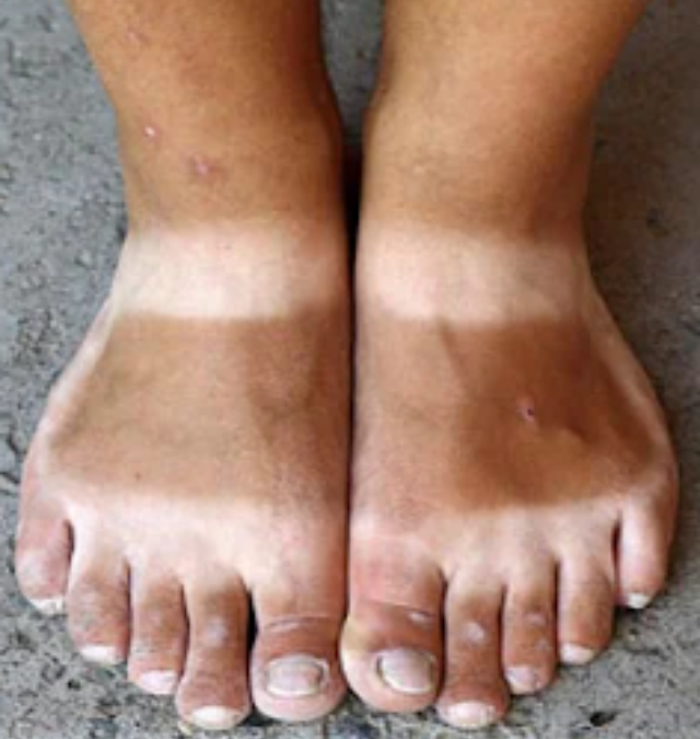 Ugly Sandal Marks on Your Feet? Try These Easy Remedies